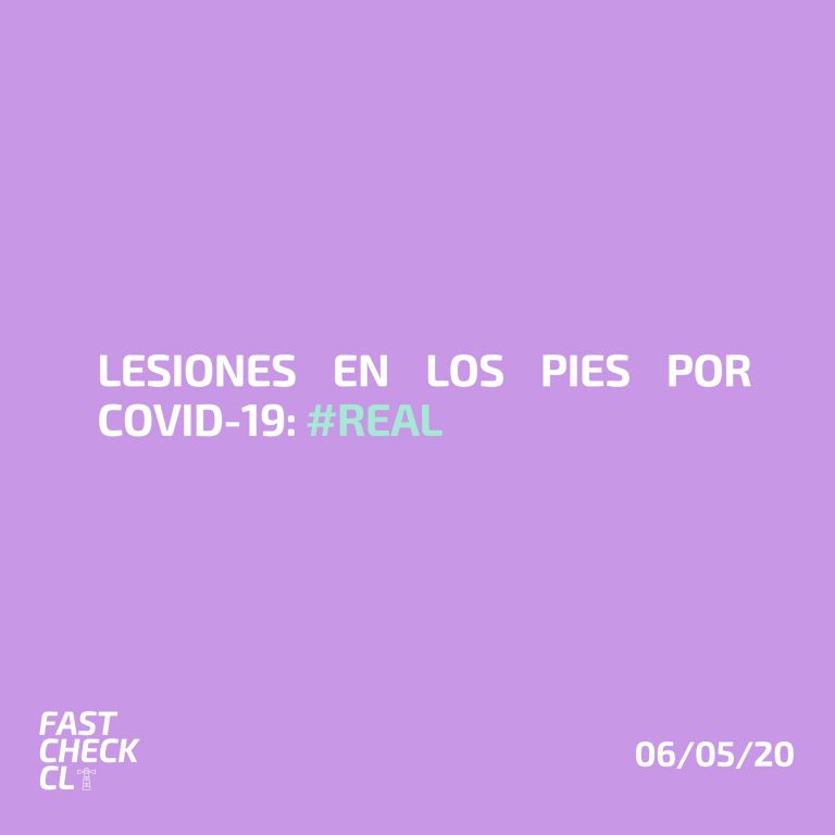 Lee más sobre el artículo Lesiones en los pies por Covid-19: #Real