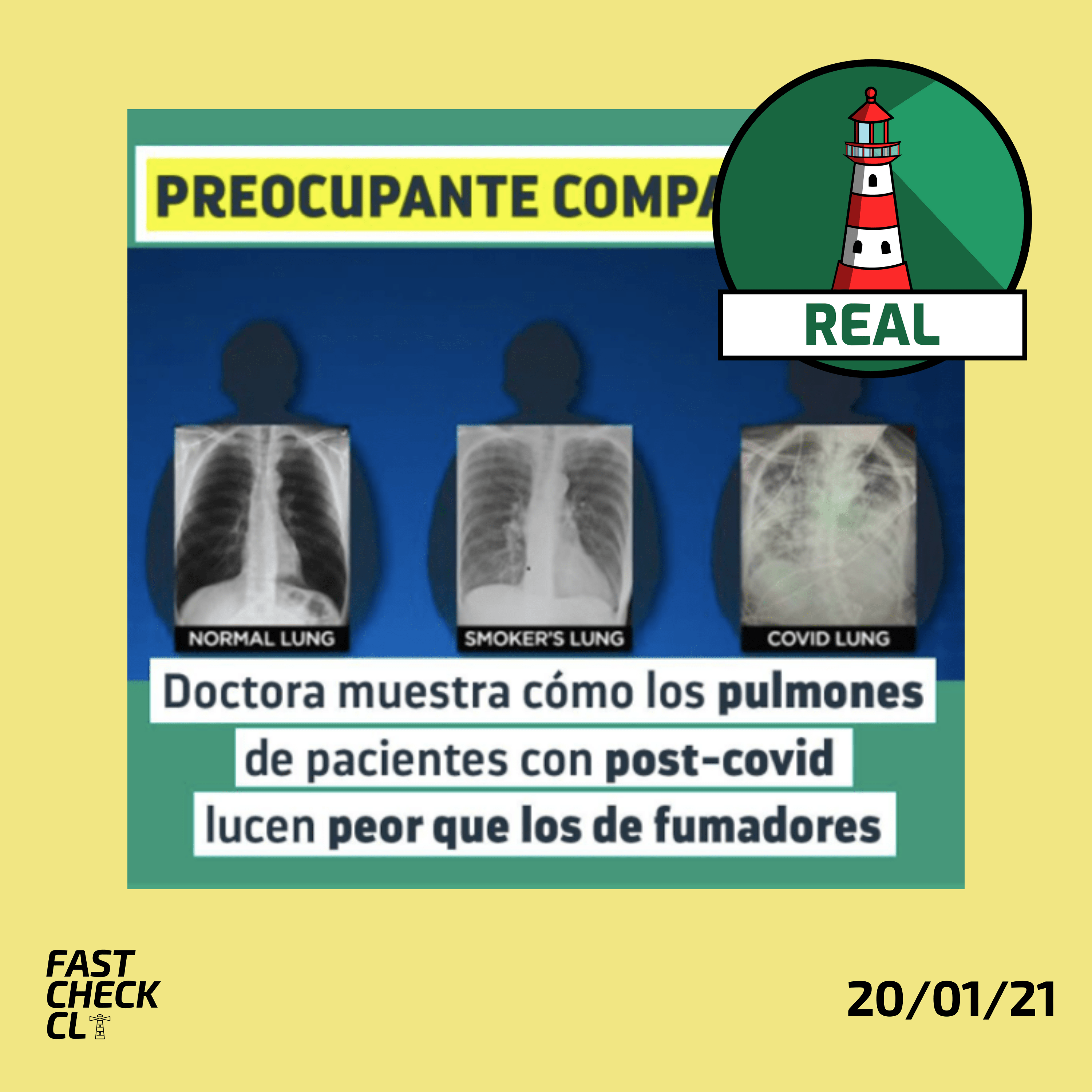 Read more about the article (Imagen) “Doctora muestra cómo los pulmones de pacientes post-Covid lucen peor que los de fumadores”: #Real